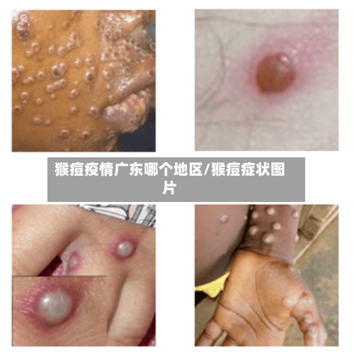 猴痘疫情广东哪个地区/猴痘症状图片-第1张图片